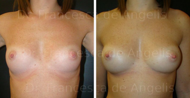 Chirurgia estetica del seno a Napoli
